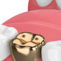 What are the two disadvantages of gold?